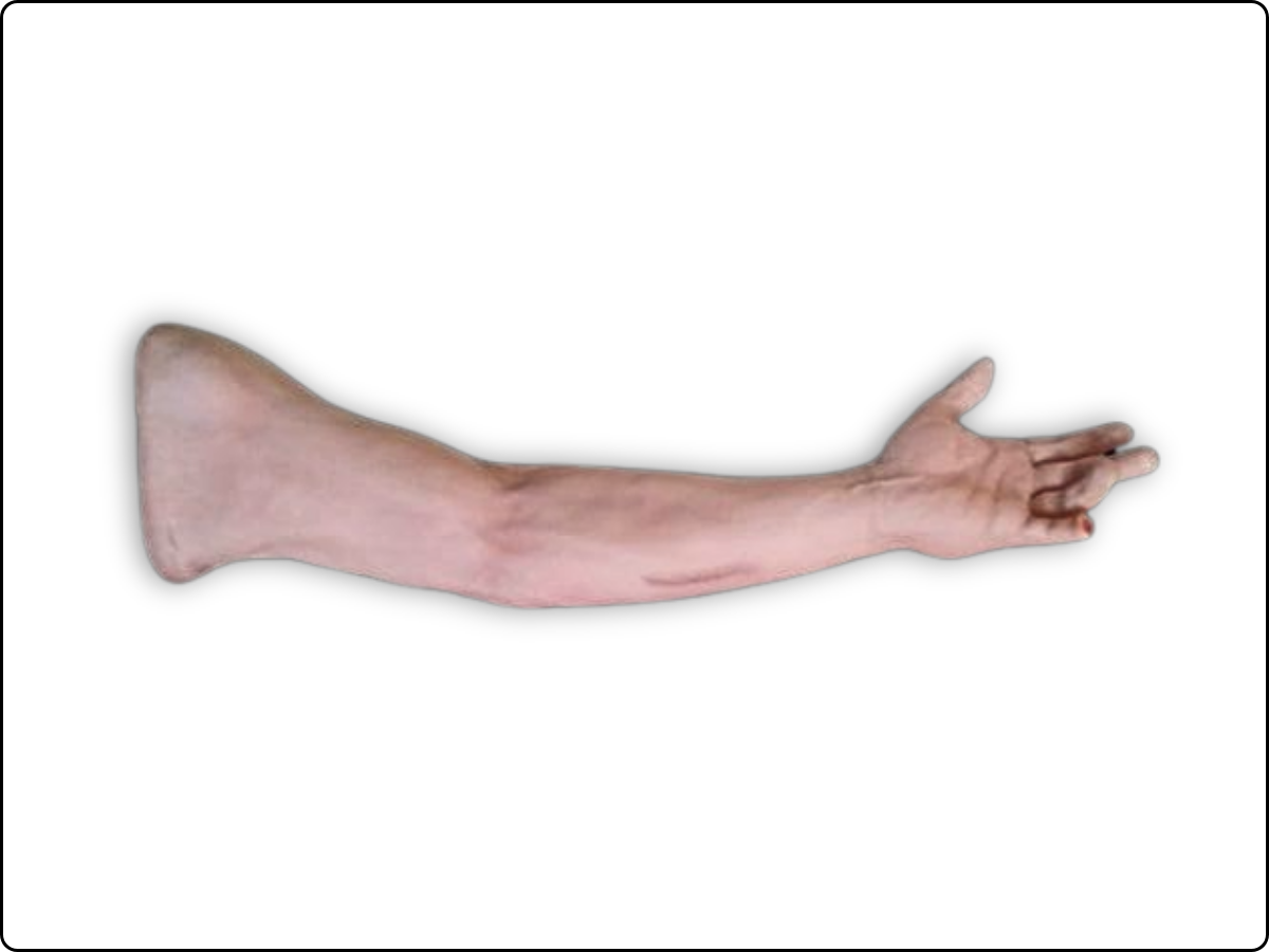Scar Revision Arm image 2